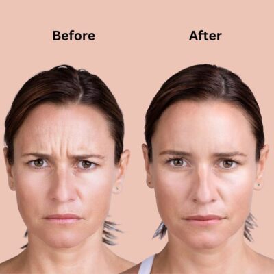 Buy Xeomin Online Clear Unwanted Wrinkles